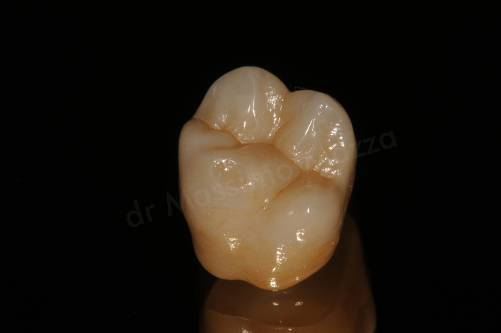 Estetica dentale: le corone metal-free, un’alternativa vera alla metallo-ceramica tradizionale