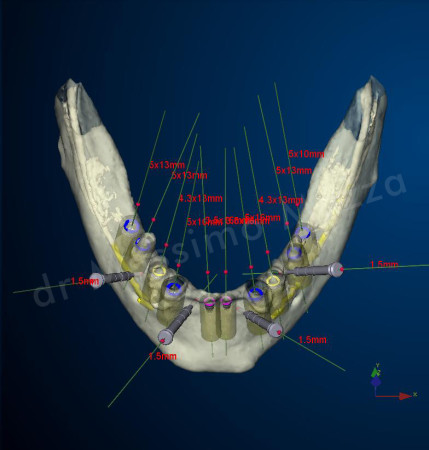 dettaglio di progettazione implantologica virtuale