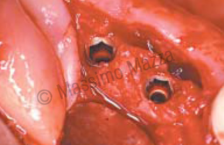 Fig. 13 - Aspetto dell' osso perimplantare