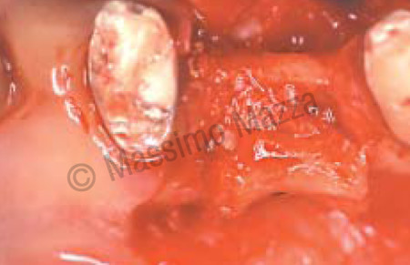 Fig. 6 - Espansione chirurgica del sito implantare