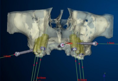 Doc Massimo Mazza - Dental Implantology
