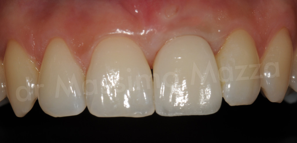 Estetica Dentale: “implantologia a carico immediato nell’area del sorriso”